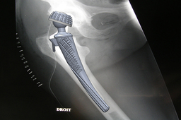 PROSTHESIS