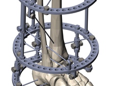GA Ilizarov fixation device