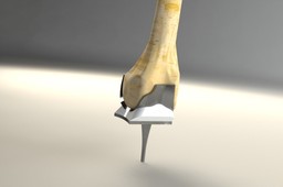Knee Implant