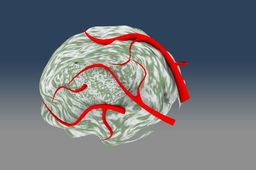 Tumor_Small w Blood Vessels.ics