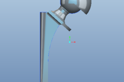 Hip Replacement